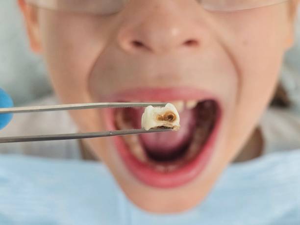 Best Emergency Tooth Extraction in Roseville, OH